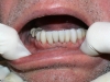 emax veneers jaw work completed