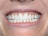 enlighten whitening work completed