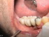 implants work completed