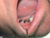 implants during