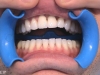 incisor implant work completed