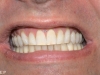 new enlighten whitening before