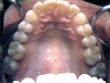 white fillings completed