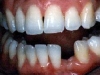 implants_implant1