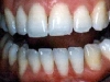 implants_implant2
