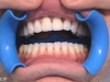 implants_incisor_after