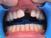 implants_incisor_before