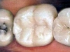 white_filling_amalcomp2