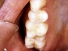 white_filling_bdafter