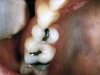white_filling_bdbefore