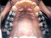 white_filling_sml5b